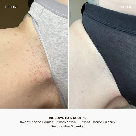 Sweet Escape Ingrown Hair Oil