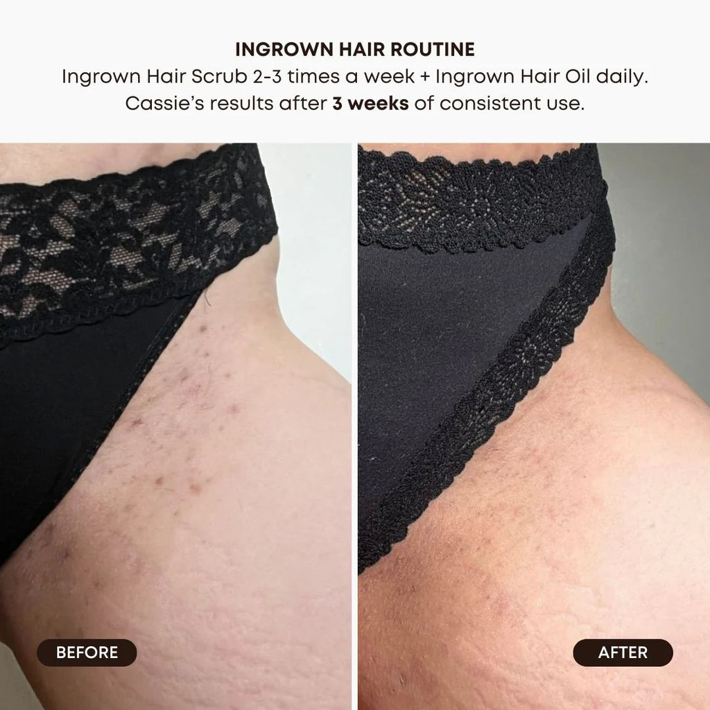 Summer Vacay Ingrown Hair Oil